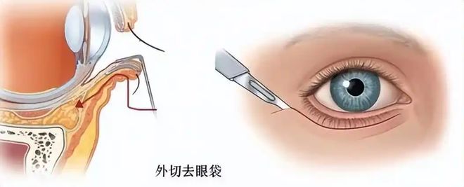 较好的技术？拉皮手术面部提升无锡苏州杭州AG旗舰厅·(中国)网站去除眼袋有什么比(图2)